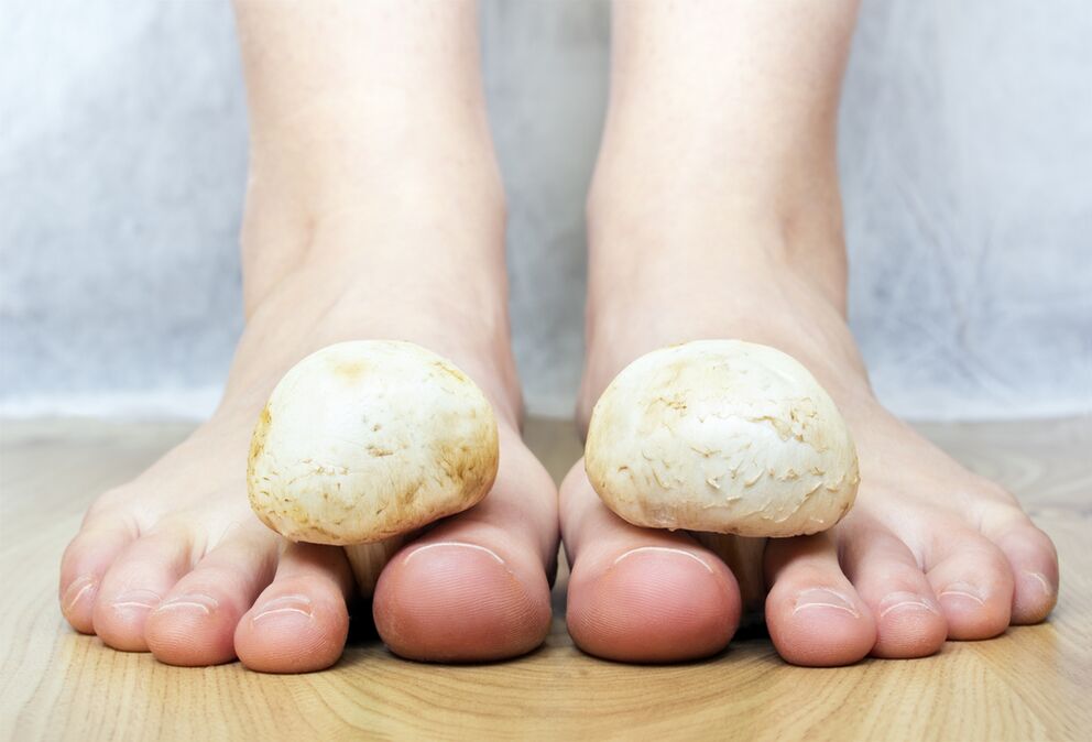 Champignon commun des ongles des pieds